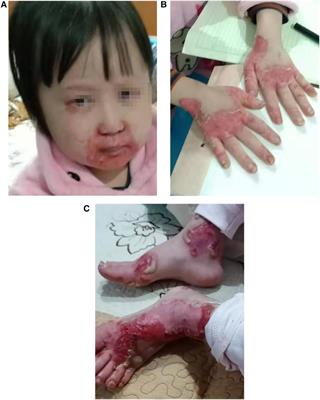 Case report: Acrodermatitis enteropathica result from a novel SLC39A4 gene mutation